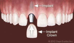 implants-1